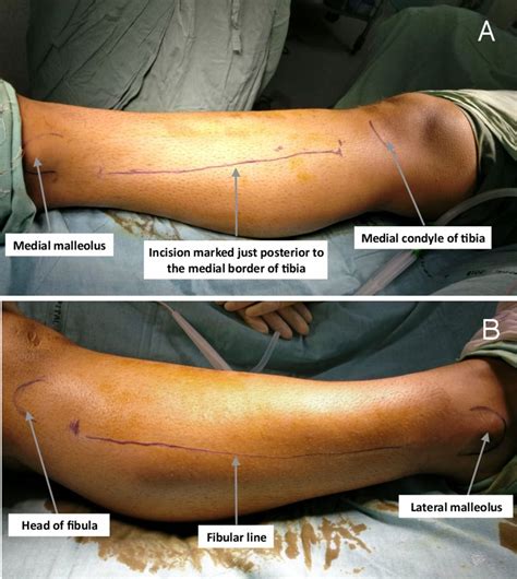 Compartment syndrome of the non-injured limb | BMJ Case Reports