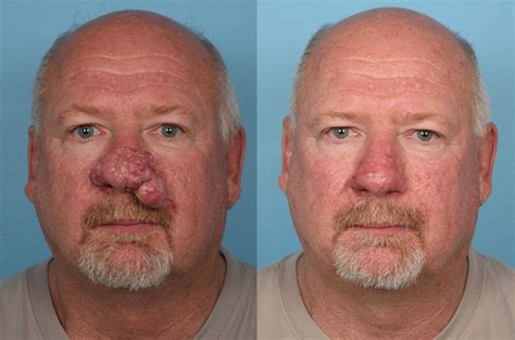 Rhinophyma Treatment | Plastic Surgery Chicago,IL |Dr. Sidle