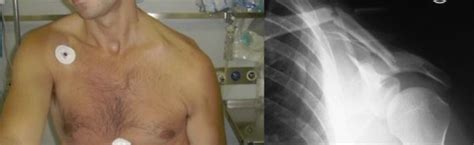 Clinical and Xray images of floating shoulder. | Download Scientific Diagram