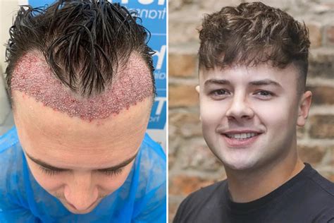 Brit, 26, left with horrific scars after botched £1,250 hair transplant in Turkey | The US Sun
