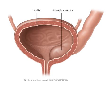 Congenital malformation in the urinary tract - Patient Information