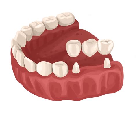 What is a dental bridge? | Authority Dental