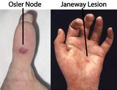 Janeway Lesions