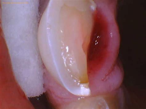 Tooth Split In Half Vertically: What To Do - 1311 Jackson Ave Dental | Dentist in Long Island ...