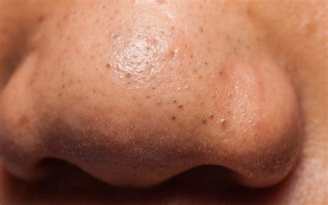 Blackheads on Nose: Causes, Remedies, and Prevention Tips - The Derm Spot