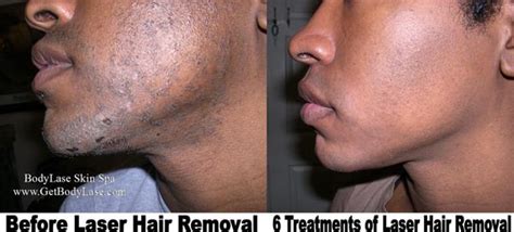 Laser Hair Removal Raleigh & Cary | BodyLase® Med Spa NC