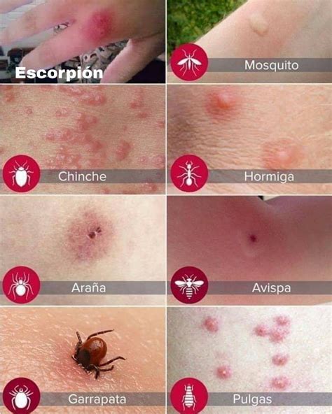 Cómo Identificar Una Picadura De Insecto Y Qué Hacer Con Ella Vida ...