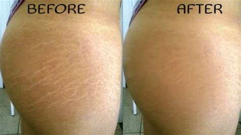 How to Naturally Get Rid of Stretch Marks