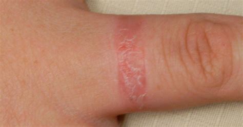 Ring rash: Causes, symptoms, and treatment