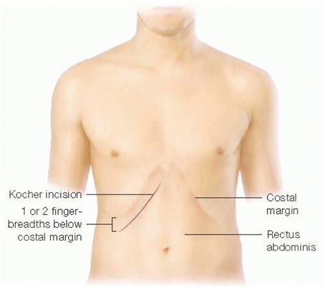 Open Cholecystectomy | Basicmedical Key