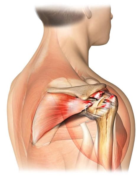 The 4 Signs of a Torn Rotator Cuff | Rotator cuff tear, Shoulder joint and Rotator cuff