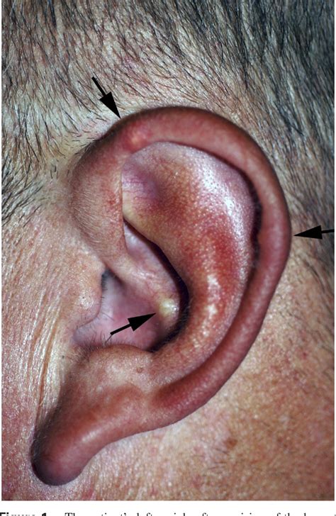 Auricular tophi as the initial presentation of gout | Semantic Scholar