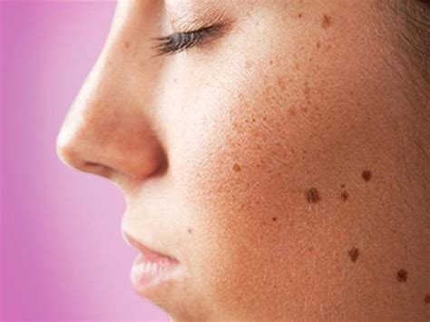 Get Rid Of Skin Tags, Moles, Blackheads, Spots And Warts Naturally And Get Flawless Skin - Small ...