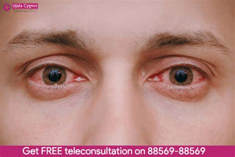 Have you sensed pain in your eyes while blinking? - Ujala Cygnus