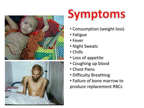 PPT - Tuberculosis PowerPoint Presentation, free download - ID:2176707