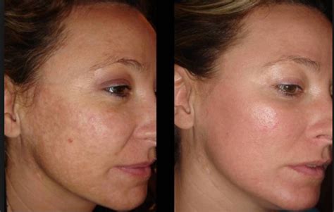 Post-inflammatory Hyperpigmentation is a skin condition in which the skin discoloration is seen ...