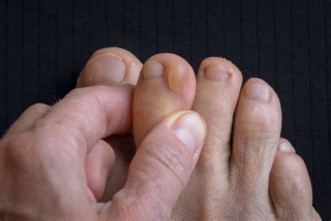 What Causes Blisters on the Toes? (2022)