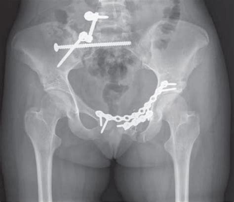 Pelvic Fractures - OrthoInfo - AAOS