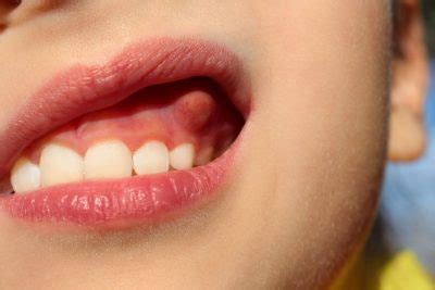 Bump on Your Gums - Dental Conditions | Dental Arts San Diego