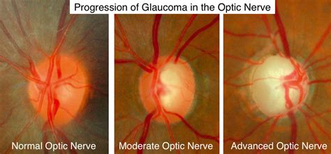 Glaucoma Specialists - Tradewinds Eye Care & Optical