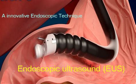 Endoscopic Ultrasound : A innovative Endoscopic Technique