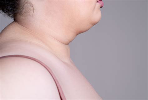 Neck Fat Causes: Reduce It with Surgery, Chewing Gum, etc.