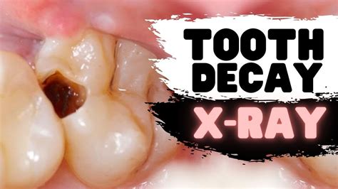 Tooth Decay on Dental X-ray | Can YOU Spot the Cavity? - YouTube