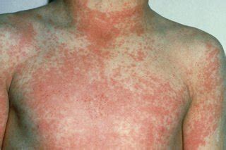 Scarlet Fever (Group A Strep) :: Frimley HealthierTogether