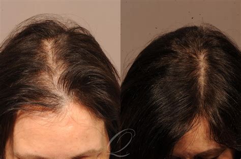 Female FUT Hair Transplant Before & After Photo Gallery | Rochester ...