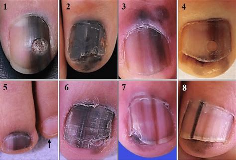 Melanoma Under Toenail Prognosis