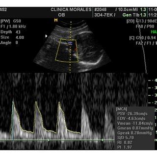 The placenta succenturiata after delivery. An inferior | Download Scientific Diagram