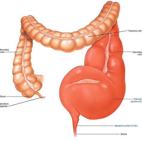 Hirschsprung's Disease - Atlas of pathophysiology, 2 Edition