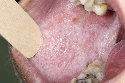 Types Of Oral Lichen Planus