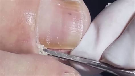 NAIL INGROWN REMOVAL - COMPILATION (#1) | EXTREMELY SATISFYING! - YouTube
