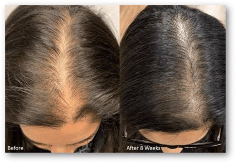 Laser Hair Restoration - REDJuvenation - Dallas, PA