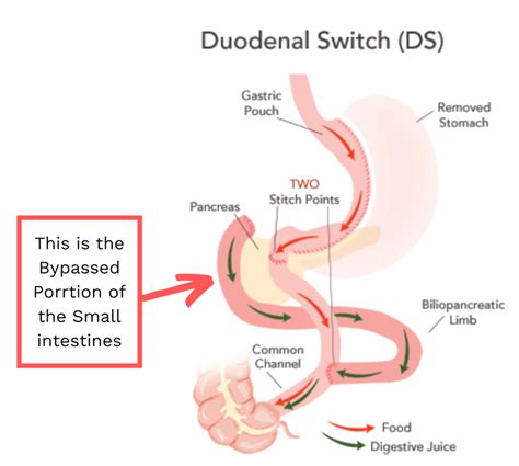Duodenal Switch Surgery, Is It Better Than VSG and Bypass?