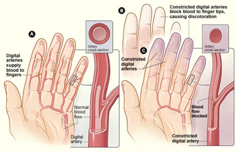 Pin on EDS Ehlers Danlos Syndrome