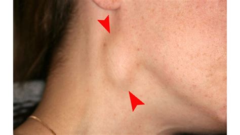 Posterior Cervical Lymph Nodes Swollen Causes