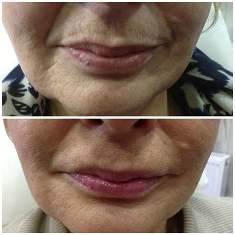 Dermal Fillers subtly rejuvenates this lady's face around her mouth and upper lip. www ...
