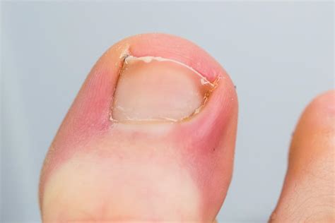 Symptoms and Treatments for Ingrown Toenails