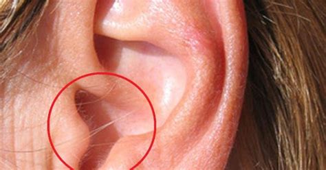 Having Hair in Your Ear Is A Warning Sign! | Ear wax removal, Tinnitus remedies, Ear infection ...