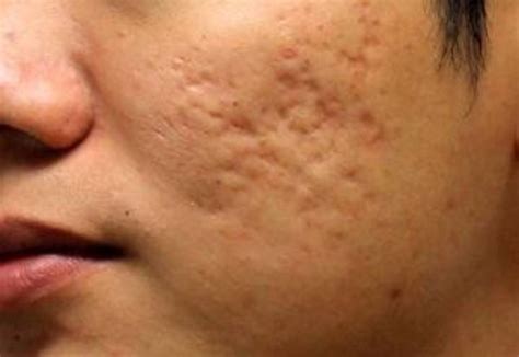 Acne Scar Treatment & Removal in Singapore | SL Aesthetic Clinic