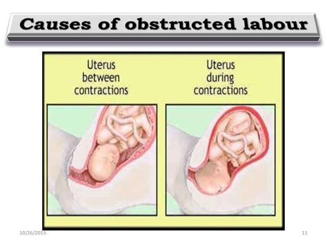 Obstructed labour