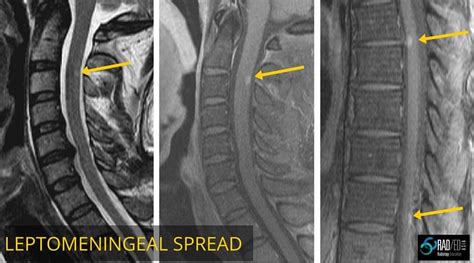 MRI SPINAL CORD COMPRESSION : WHEN TO GIVE CONTRAST (UPDATED 2021) - Radedasia