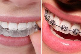 Clip On Braces For Teeth, Samadhan Clip Braces Dental Clinic Dentists Book Appointment Online ...