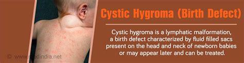 Cystic Hygroma (Birth Defect) - Causes, Symptoms, Diagnosis Treatment and Prognosis