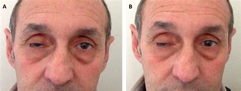 Ophthalmoparesis and unilateral finger flexor muscle weakness in seronegative myasthenia gravis ...