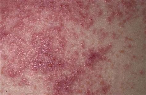 Dermatitis Herpetiformis (Celiac Disease Rash) Photos