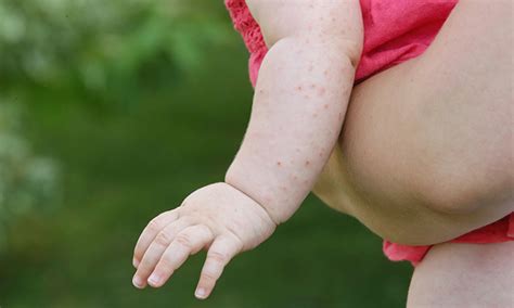 Baby Heat Rash: Symptoms, Prevention and Treatment | Pampers