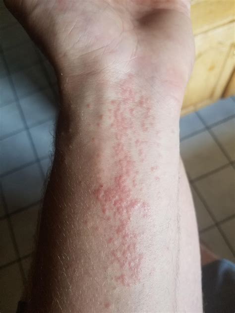 Have a persistent rash on my left forearm. Any ideas or should I visit a doctor? : r/medical